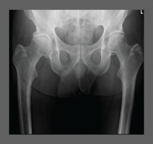 Right-hip-osteoarthritis