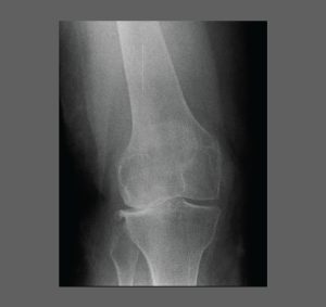 Knee Osteoarthritis