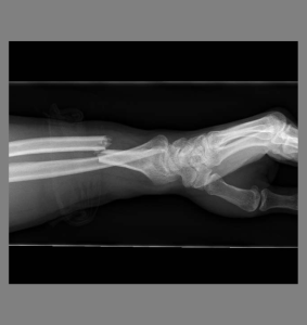 Distal 1/3rd radius fracture