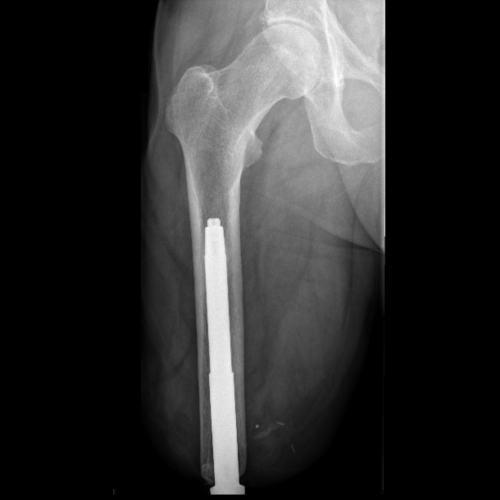 image of after osseointegration