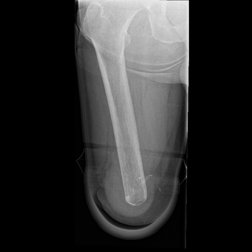 image of before osseointegration