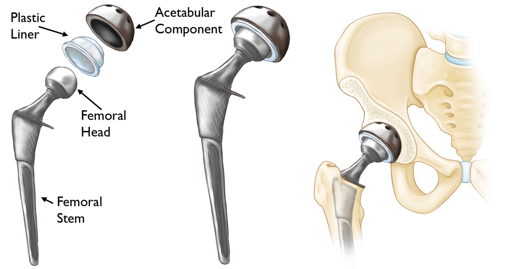 hip revision detailed diagram