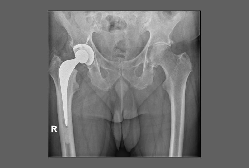 robotic assisted surgery hip replacement example